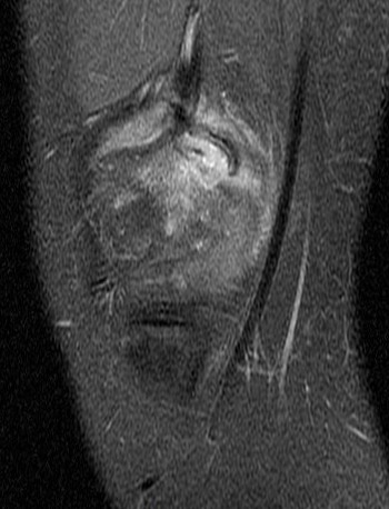 Figure 2 for case avulsion fracture MFC and tibial tubercle fx ( RID2896 ) ( RID4653 )